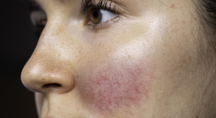 banner of Many People With Rosacea Dislike the Appearance Of Their Skin