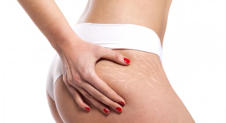 banner of Dealing with Stretch Marks