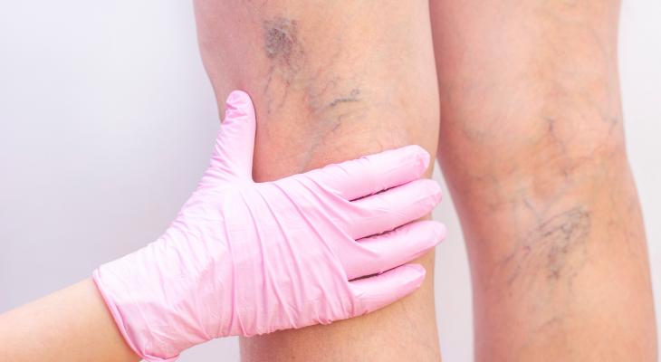 banner of Unsightly Varicose Veins Are Rarely Desired Features (newstyle)