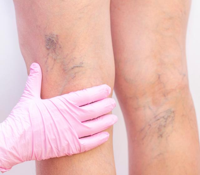 square of Unsightly Varicose Veins Are Rarely Desired Features (newstyle)
